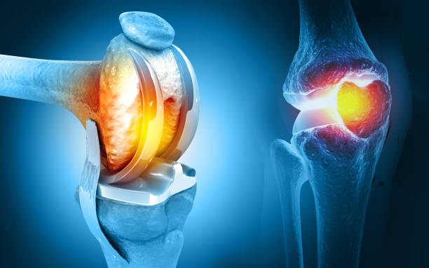 3D Medical Knee Replacement Surgery
